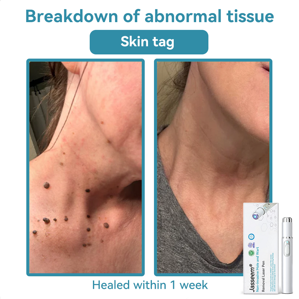 𝐉𝐚𝐬𝐬𝐞𝐞𝐦® 💛𝐍𝐨𝐧-𝐢𝐧𝐯𝐚𝐬𝐢𝐯𝐞 𝐌𝐨𝐥𝐞 𝐚𝐧𝐝 𝐖𝐚𝐫𝐭 𝐑𝐞𝐦𝐨𝐯𝐚𝐥 𝐋𝐚𝐬𝐞𝐫 𝐏𝐞𝐧 (Quick and painless removal of warts, moles, age spots and skin tags - without any side effects)