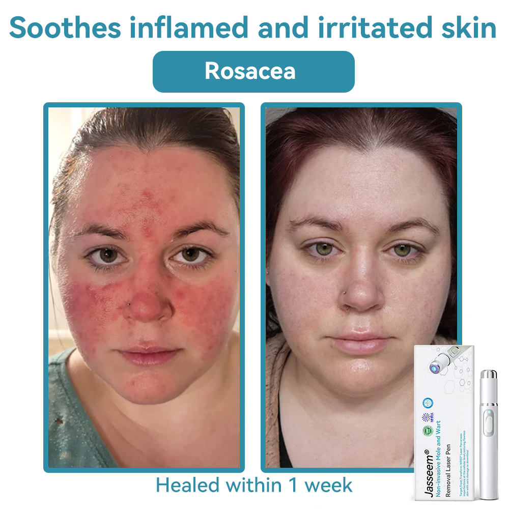 𝐉𝐚𝐬𝐬𝐞𝐞𝐦® 💛𝐍𝐨𝐧-𝐢𝐧𝐯𝐚𝐬𝐢𝐯𝐞 𝐌𝐨𝐥𝐞 𝐚𝐧𝐝 𝐖𝐚𝐫𝐭 𝐑𝐞𝐦𝐨𝐯𝐚𝐥 𝐋𝐚𝐬𝐞𝐫 𝐏𝐞𝐧 (Quick and painless removal of warts, moles, age spots and skin tags - without any side effects)